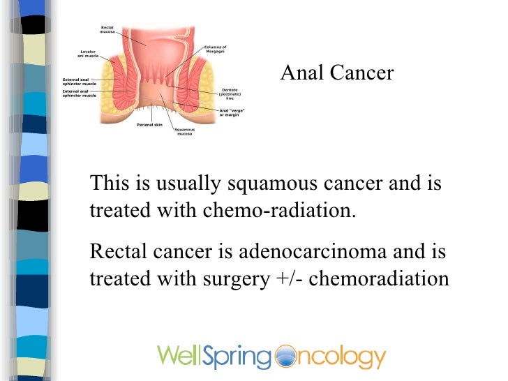 Diagnosing Anal Cancer